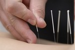 acupuncture